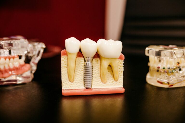 A dental model showing crowns and an implant